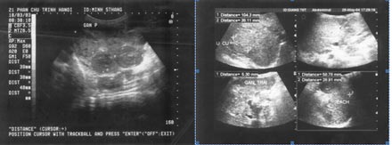 Tinh nghệ trị được những loại ung thư nào? - 2