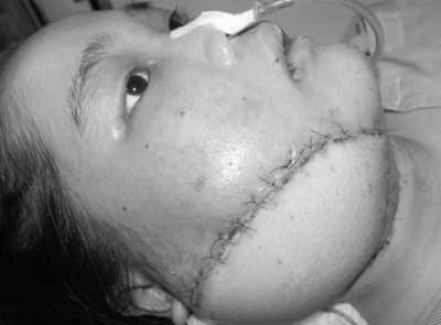 Gần 20 giờ cứu bệnh nhân có khối dị dạng “đồ sộ” trên má  - 1