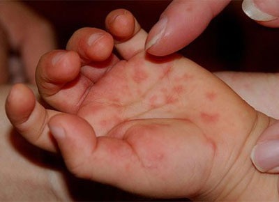 “Mắc bệnh” thành tích, không công bố dịch tay chân miệng?  - 1