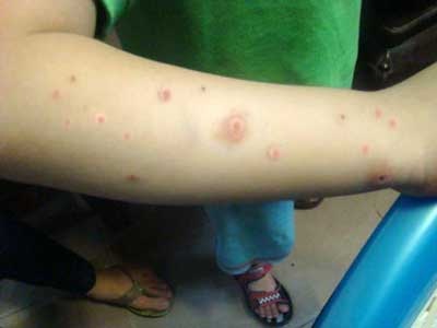 Kết luận của Bộ Y tế về việc dùng Anolyt chữa tay chân miệng - 1 Kết luận của Bộ Y tế về việc dùng Anolyt chữa tay chân miệng - 1