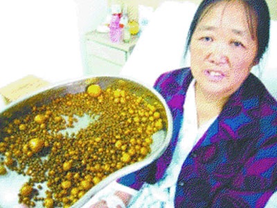 Hơn 2.000 viên sỏi trong túi mật “khổng lồ” - 2