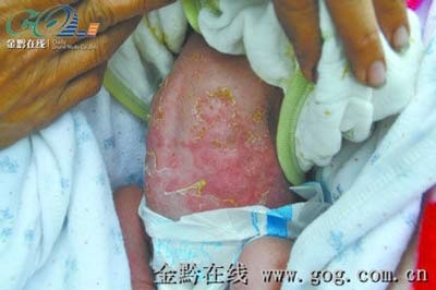 Trung Quốc: Bé gái nghi dị ứng da do sữa tắm Johnson & Johnson - 1 Trung Quốc: Bé gái nghi dị ứng da do sữa tắm Johnson & Johnson - 1