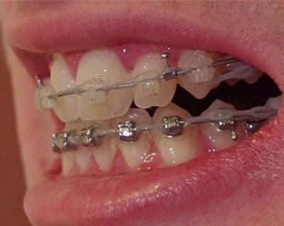 Làm gì khi răng mọc chen chúc? - 3