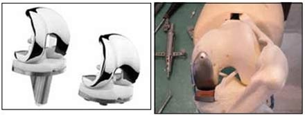 Phẫu thuật và quản lý sau phẫu thuật thay khớp gối - 1