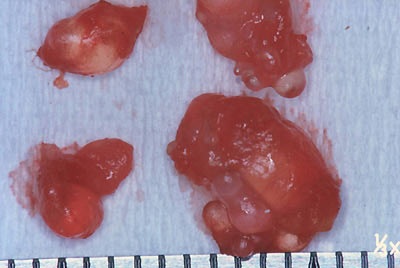 Đi siêu âm mới biết túi độn ngực bị vỡ - 1