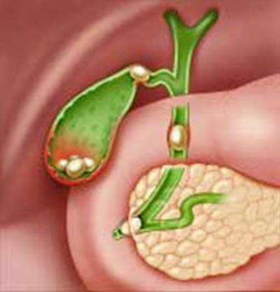 Sỏi thận thường “đồng hành” cùng sỏi mật - 1