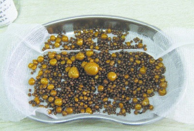 Hơn 2.000 viên sỏi trong túi mật “khổng lồ” - 1