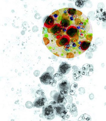 Ai có nguy cơ mắc sỏi thận? - 1