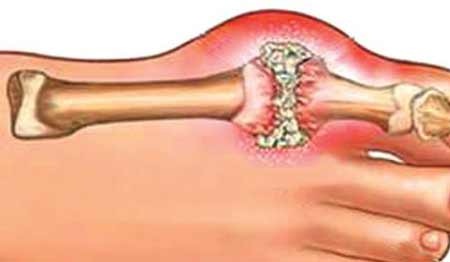 Bệnh Gout Nguyên Nhân, Các Thực Phẩm Nên Ăn, Không Nên Ăn Và Cách Phòng Tránh