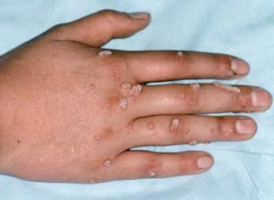 Dễ lây lan như mụn cóc - 1 Dễ lây lan như mụn cóc - 1