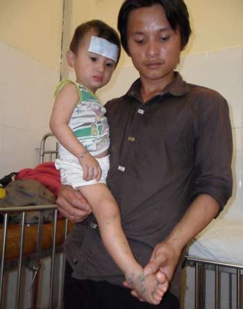 Đắk Lắk: Bệnh tay chân miệng tăng đột biến - 2