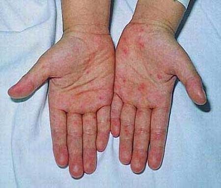 Công bố hướng dẫn mới điều trị bệnh tay chân miệng - 1 Công bố hướng dẫn mới điều trị bệnh tay chân miệng