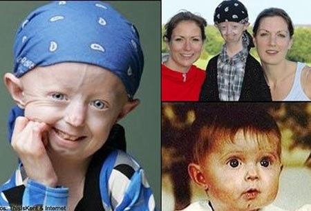 Căn bệnh quái ác biến bé gái thành cụ già 100 tuổi