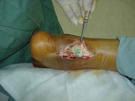 Tiêm thuốc giảm đau, cụ ông bị đứt gân chân