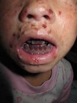 Phát hiện bệnh 'ma cà rồng' tại Việt Nam - 1 Phát hiện bệnh 'ma cà rồng' tại Việt Nam