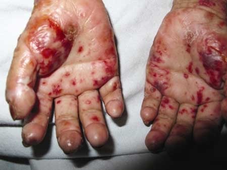 Phát hiện bệnh 'ma cà rồng' tại Việt Nam - 2 Phát hiện bệnh 'ma cà rồng' tại Việt Nam