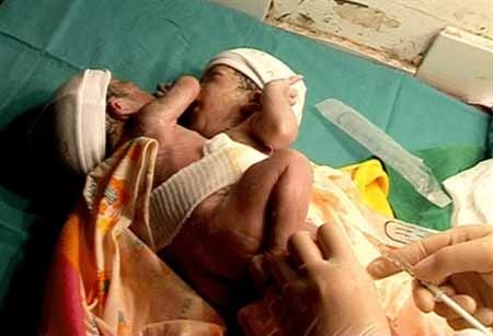 Hai bé sinh đôi dính liền nhau, không hậu môn - 1 Hai bé sinh đôi dính liền nhau, không hậu môn