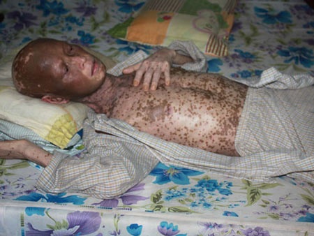 Anh Điền đang nằm tại nhà vì không còn tiền để vào bệnh viện chữa bệnh. Ảnh: T.T