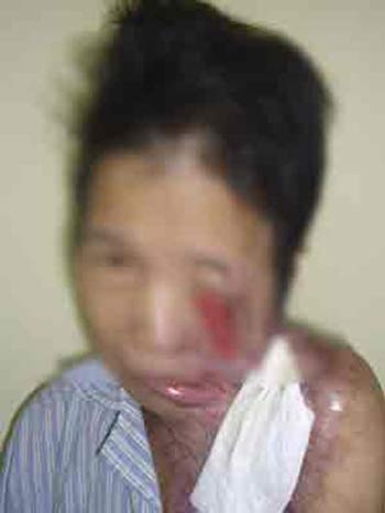 Mất tai, biến dạng mặt… vì đắp thuốc nam - 1 Bệnh nhân P bị biến dạng mặt do đắp thuốc nam chữa bỏng