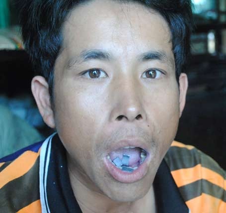 Nhiều người chết trẻ vì mưu sinh bằng... miệng - 1 Người dân Mỹ Thạnh mưu sinh bằng nghề độc