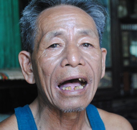 Nhiều người chết trẻ vì mưu sinh bằng... miệng - 2 Hàm răng của ông Phan Cường tan nát vì làm nghề cắn chì