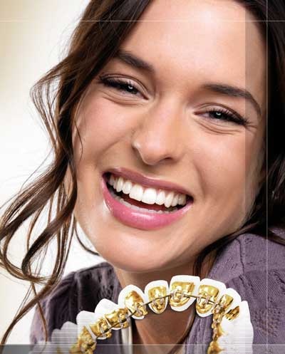 Có thể niềng răng mà không ai biết? - 1 Có thể niềng răng mà không ai biết?