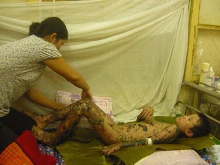 Dị ứng thuốc: Đã mắc là nặng! - 1 Dị ứng thuốc: Đã mắc là nặng!