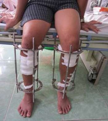 Phẫu thuật kéo dài chân: Không ngắn cũng kéo - 1 Bệnh nhân này đã được phẫu thuật để nâng thêm 7cm chiều cao.