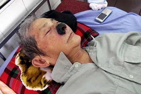 Những con dòi gắp ra được từ mũi của ông Tự. Ảnh: Việt Hoa