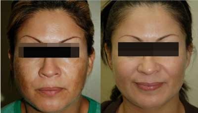 Trị tận gốc nám tàn nhang và đốm nâu - 4 Cảm nhận khách hàng sau khi sử dụng sản phẩm: