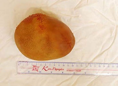 Viên sỏi bàng quang nặng 0,8kg - 1 Viên sỏi nặng 0,8kg