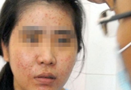 Dùng kem làm trắng da Hàn Quốc, mặt sưng phù - 1 Dùng kem làm trắng da Hàn Quốc, mặt sưng phù