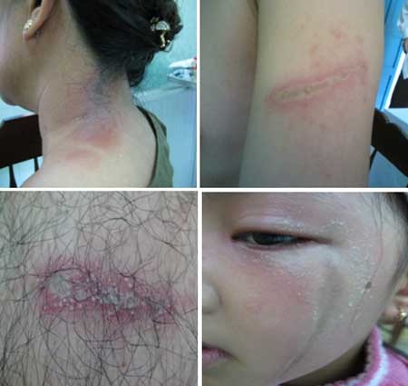 80% bác sĩ nhầm lẫn giữa viêm da tiếp xúc do côn trùng và zona - 1 Một số hình ảnh viêm da tiếp xúc gây ra bởi côn trùng