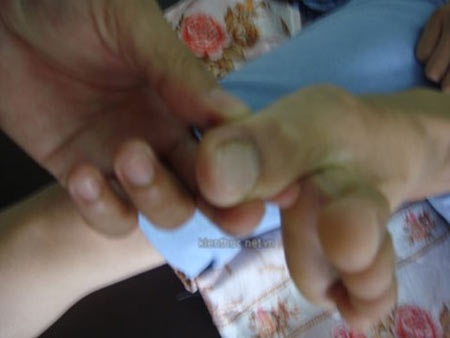 Những ca bệnh hy hữu do bất cẩn trong năm 2012 - 1 Vết chuột cắn trên ngón chân cái trái của bệnh nhân