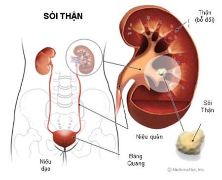 Trị sỏi thận đúng cách - 1 Những trường hợp nên phẫu thuật