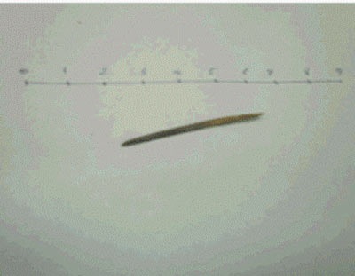 Những ca bệnh hy hữu do bất cẩn trong năm 2012 - 4 Chiếc tăm tre là thủ phạm đâm thủng ruột ông T