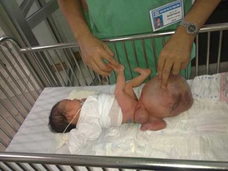 Bé B.V với khối u quái nặng hơn cơ thể (ảnh chụp trước khi phẫu thuật cắt bỏ u). Ảnh: T.Hà