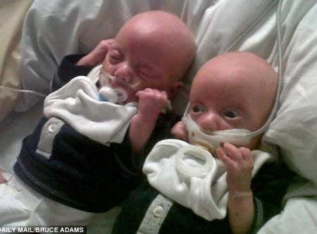 Y tá dán băng gắn ti giả vào miệng trẻ sinh non hay khóc - 1 Y tá dán băng gắn ti giả vào miệng trẻ sinh non hay khóc