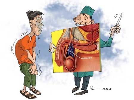 Giãn tĩnh mạch thừng tinh: đừng quá lo! - 1 Giãn tĩnh mạch thừng tinh là gì?