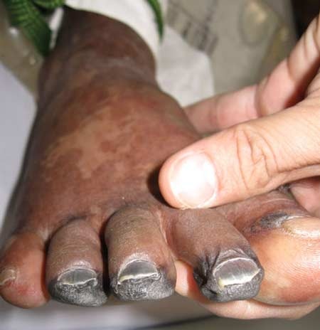 Bệnh nhân bị hoại tử đầu ngón chân