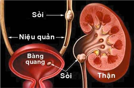 Phòng biến chứng suy thận do sỏi thận - 1 Tại sao sỏi thận lại gây ra suy thận