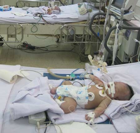 Trẻ sơ sinh bị uốn ván nhập viện tại BV Bệnh Nhiệt đới