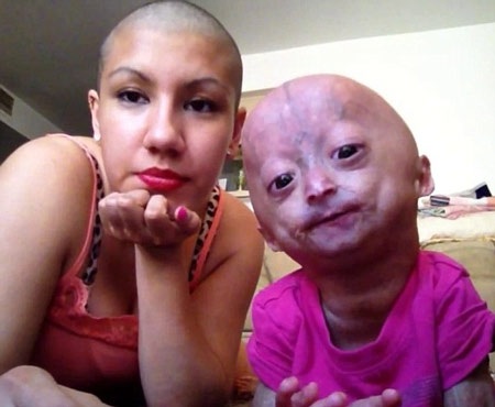 Bé 6 tuổi có thân hình bà lão - 2 Adalia Rose Williams cùng mẹ Natalia Amozurrutia