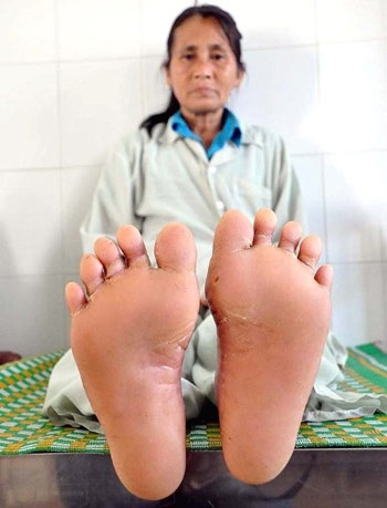 2 vợ chồng nghi mắc bệnh “da lạ” - 1 Bàn chân đang dần thuyên giảm các vết lở