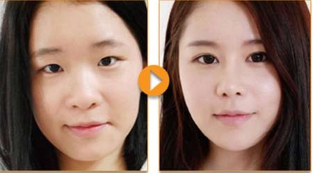 Nâng mũi S-line là gì? - 3 Hình ảnh trước và sau khi nâng mũi S-line