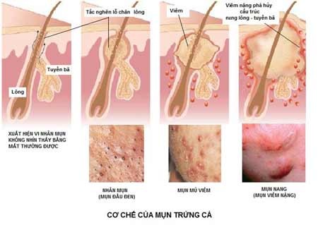 Nguyên nhân gây mụn trứng cá