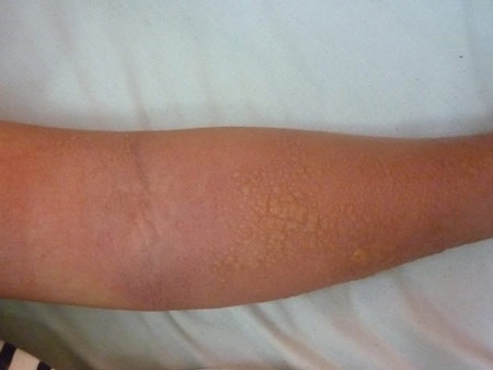 Tiêm thuốc trắng da, tiêu mỡ: Đẹp ngắn, khổ dài! - 1 Bệnh nhân bị dị ứng sau khi sử dụng các sản phẩm làm trắng da