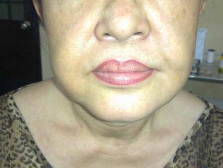 Khuôn mặt chảy xệ do tiêm silicone lỏng của một phụ nữ