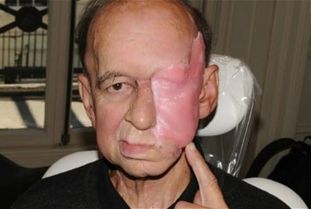 Ông Eric Moger sau phẫu thuật cắt bỏ khối u