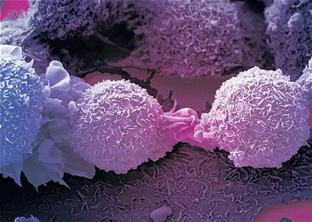 Điều trị ung thư bằng…máy tính - 1 Điều trị ung thư bằng…máy tính